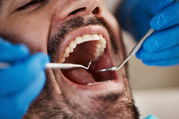Best Emergency Dental Extractions in Hamilton City, CA